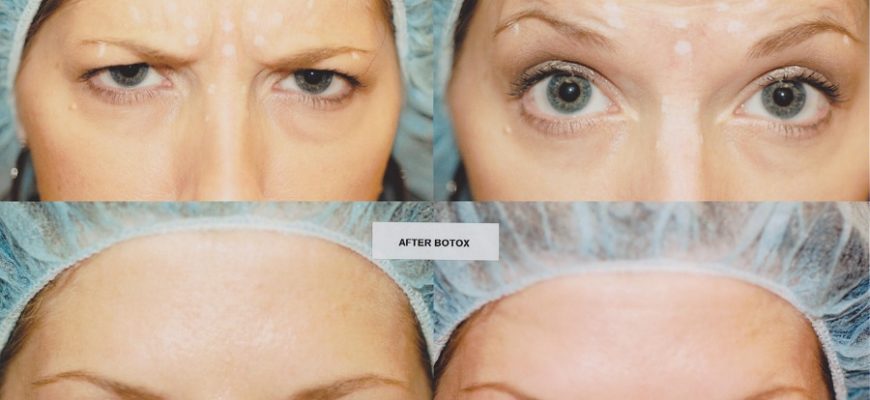 Коррекция мимических морщин с помощью диспорта и миотокса Коррекция мимических морщин с помощью диспорта и миотокса