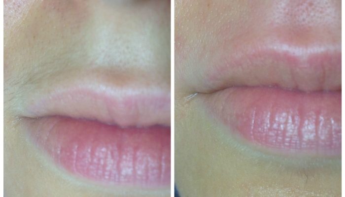 Шугаринг верхней губы