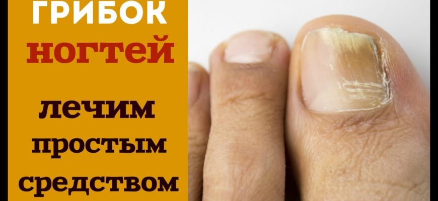 Грибок ногтей: причины и симптомы