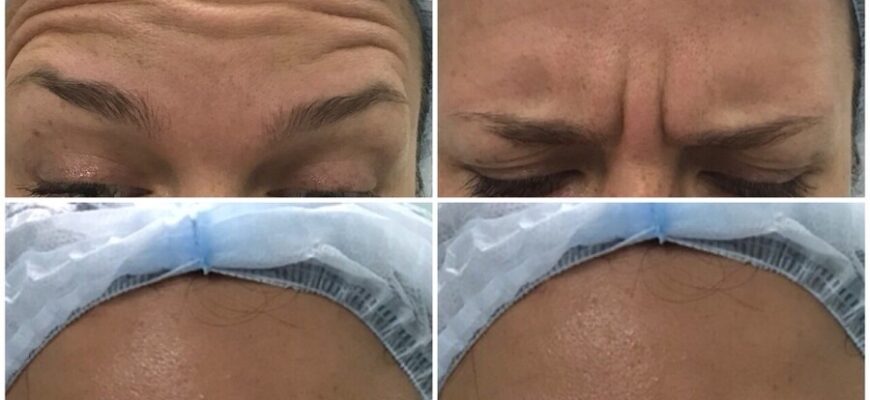 Коррекция мимических морщин