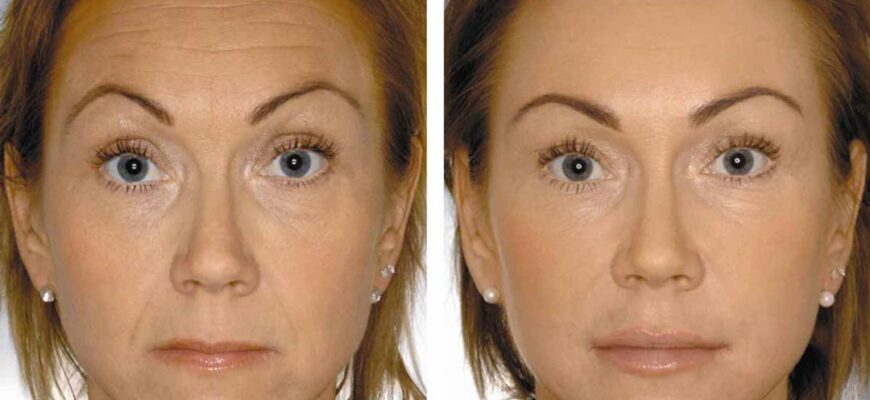 Коррекция мимических морщин с помощью диспорта и миотокса в 2024 году