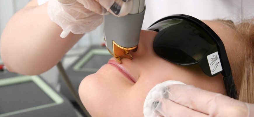 Лазерная эпиляция лица