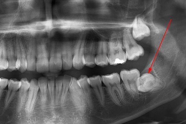 Удаление зубов в Алматы Удаление зубов в Алматы