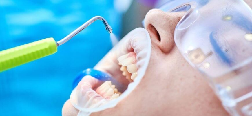 Почему важна чистка зубов у стоматолога в Сочи?