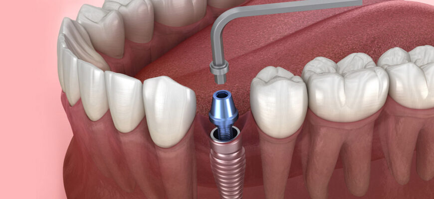Что такое коронки на зубы?