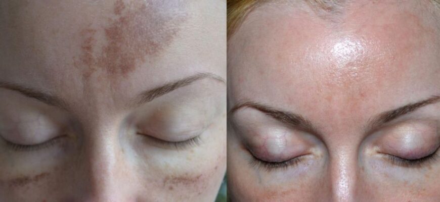 Что такое пигментация на лице?