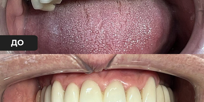 Протезирование зубов – цена в Одинцово, клиника СК-Мед