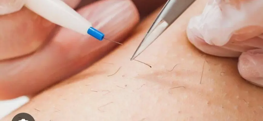 Электроэпиляция