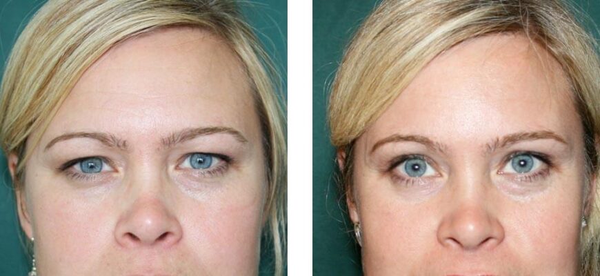 Блефаропластика век: как вернуть взгляду свежесть и уверенность Блефаропластика век: как вернуть взгляду свежесть и уверенность