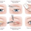Что такое Блефаропластика и её основные цели