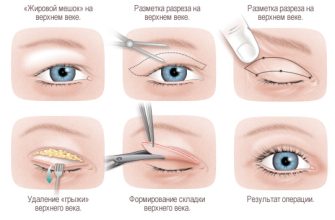 Что такое Блефаропластика и её основные цели Что такое Блефаропластика и её основные цели