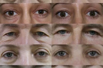 Что такое Блефаропластика и ее цели