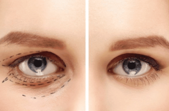 Что такое Блефаропластика и ее основные цели Что такое Блефаропластика и ее основные цели