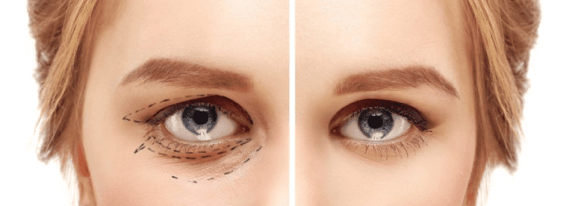 Что такое Блефаропластика и ее основные цели