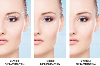 Что такое Блефаропластика и её суть Что такое Блефаропластика и её суть