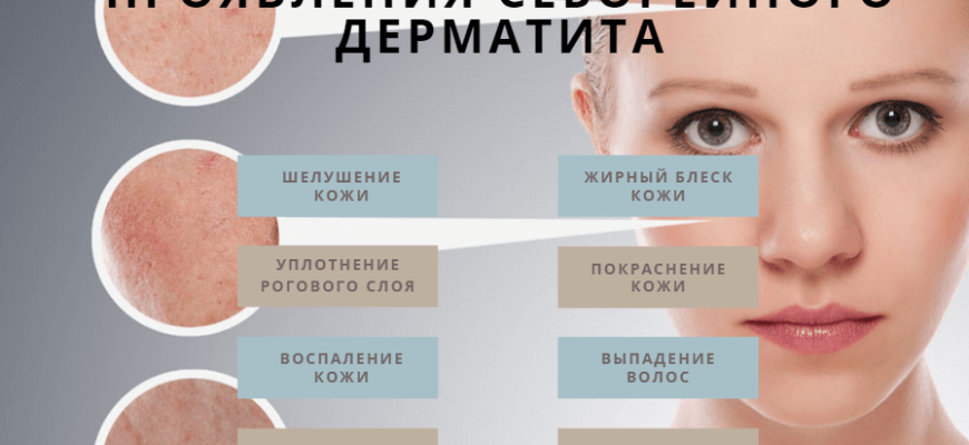 Основы себорейного дерматита и его симптомы Основы себорейного дерматита и его симптомы