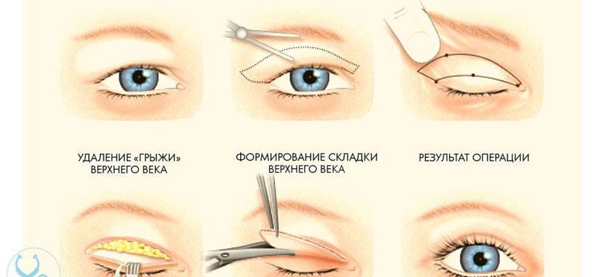 Что такое Блефаропластика и ее значение
