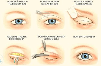 Что такое Блефаропластика и её основные задачи