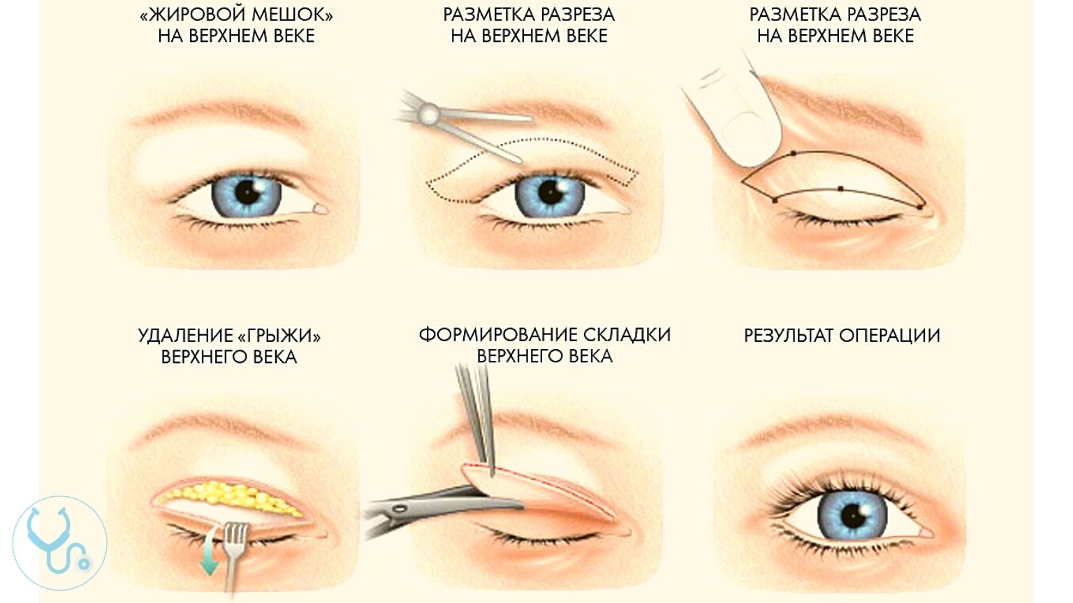 Что такое Блефаропластика и её основные задачи