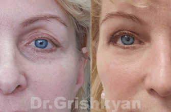 Что такое Блефаропластика и кому она подходит Что такое Блефаропластика и кому она подходит